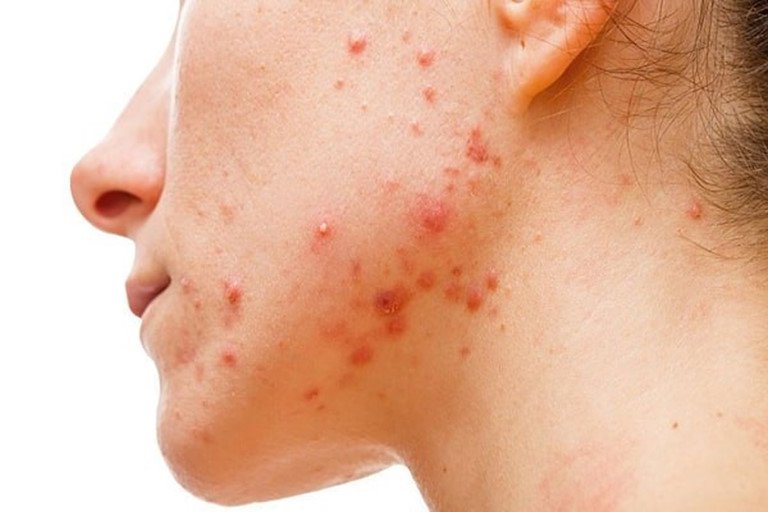 Những sai lầm khi điều trị mụn trứng cá | Vinmec
