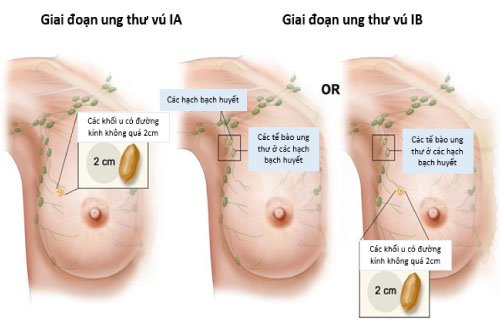 Lựa chọn điều trị ung thư vú giai đoạn III Lựa chọn điều trị ung thư vú giai đoạn III