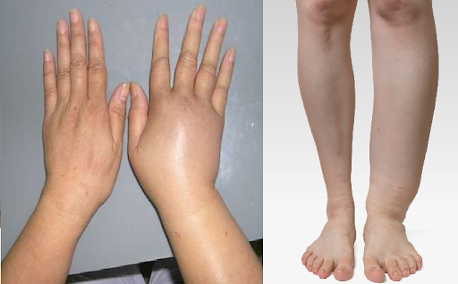 Hội chứng vùi lấp: Những điều cần biết Hội chứng vùi lấp: Những điều cần biết