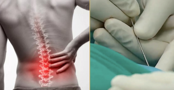 Điều trị tiêm giảm đau cột sống dưới X quang tăng sáng Điều trị tiêm giảm đau cột sống dưới X quang tăng sáng