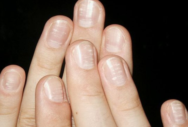 Nail psoriasis