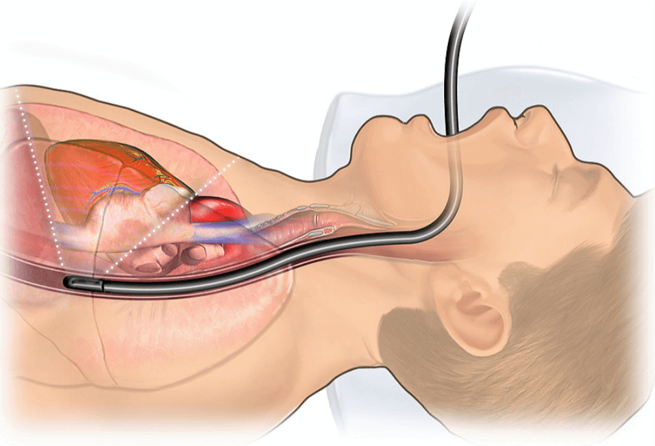 Siêu âm tim qua thực quản có đau không? Siêu âm tim qua thực quản có đau không?