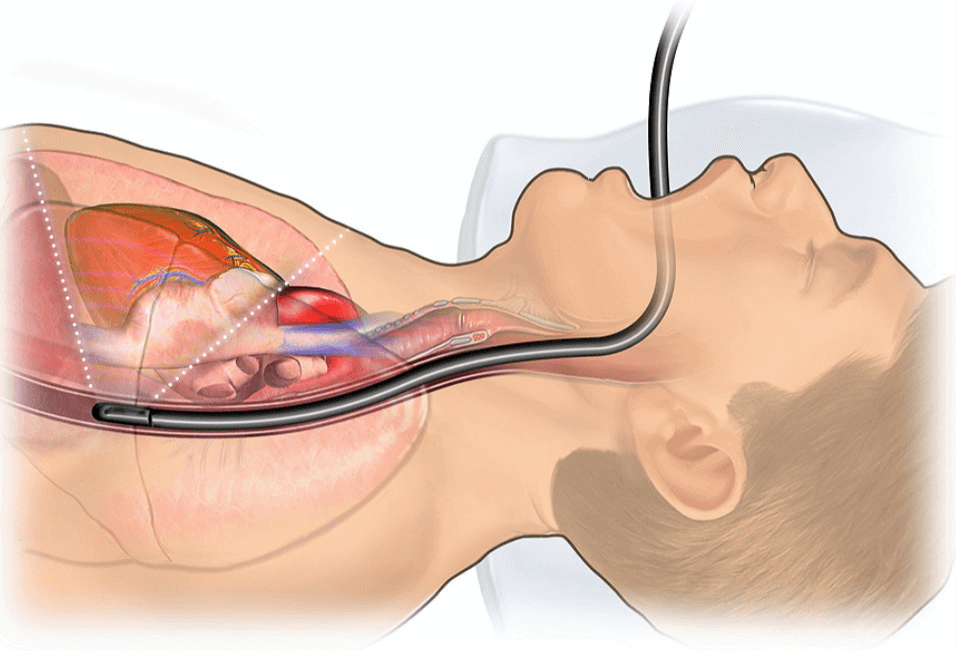 siêu âm tim qua đường thực quản