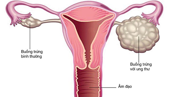 Gây tê ngoài màng cứng phẫu thuật cắt buồng trứng 2 bên Gây tê ngoài màng cứng phẫu thuật cắt buồng trứng 2 bên