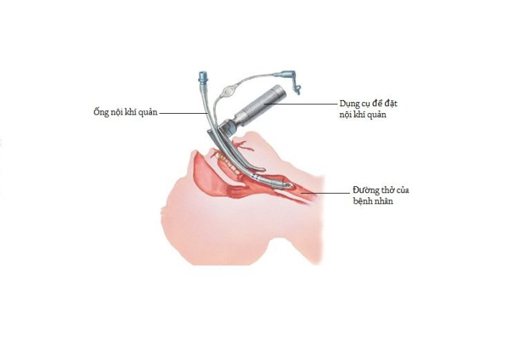 Gây mê nội khí quản phẫu thuật cho người mẹ có thai ngoài tử cung bị vỡ Gây mê nội khí quản phẫu thuật cho người mẹ có thai ngoài tử cung bị vỡ