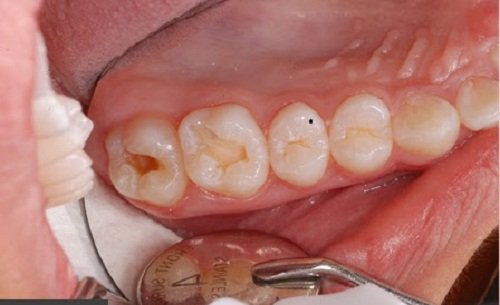 Cách chăm sóc nướu và răng mới mọc của bé Cách chăm sóc nướu và răng mới mọc của bé