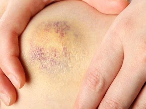 Bệnh xuất huyết giảm tiểu cầu có phải bệnh tự miễn? | Vinmec