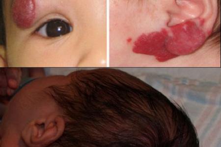 Bướu huyết thanh ở trẻ sơ sinh Bướu huyết thanh ở trẻ sơ sinh