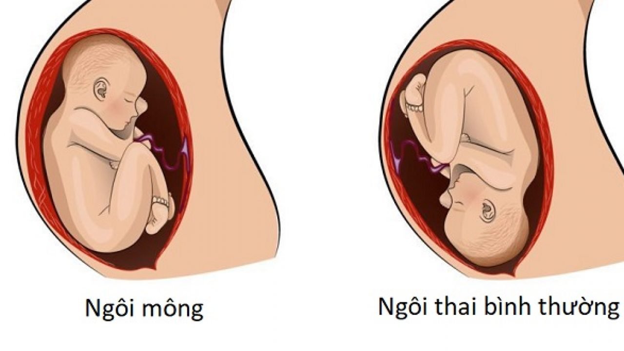 Sinh ngôi mông