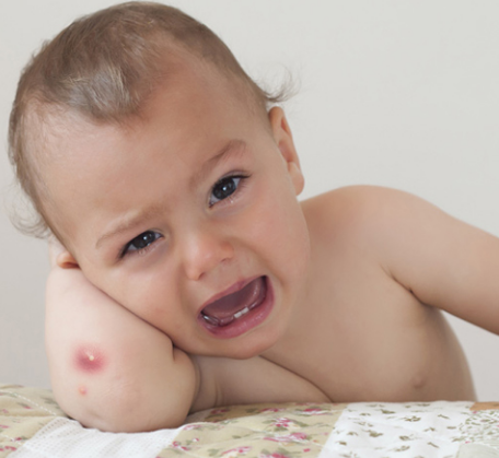 Cách chăm sóc trẻ bị nhọt | Vinmec