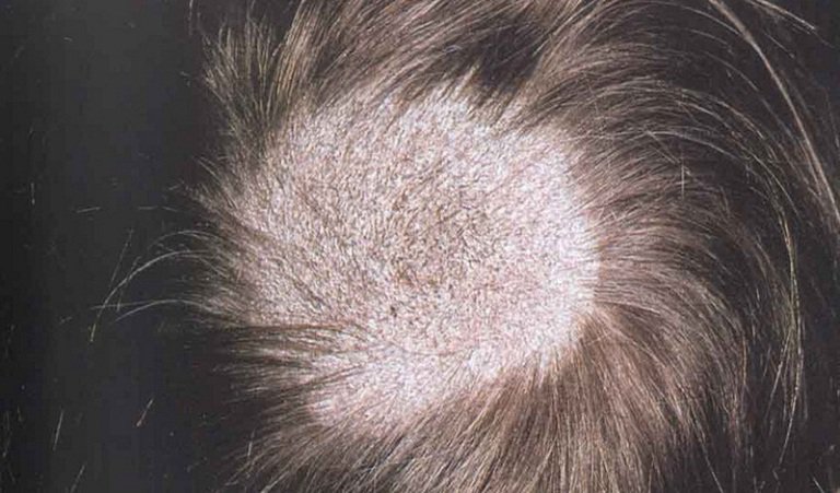 Fungal Hair Disease Causes Symptoms And Treatment Vinmec