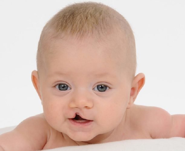 Khe hở chéo mặt: Những điều cần biết Khe hở chéo mặt: Những điều cần biết