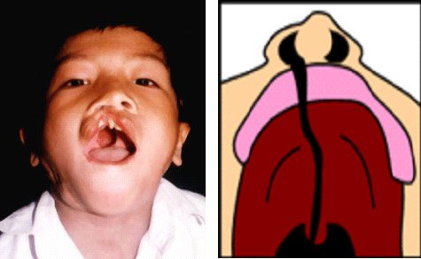Khe hở chéo mặt: Những điều cần biết Khe hở chéo mặt: Những điều cần biết