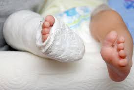 Trẻ đi nhón chân có cần can thiệp? Trẻ đi nhón chân có cần can thiệp?