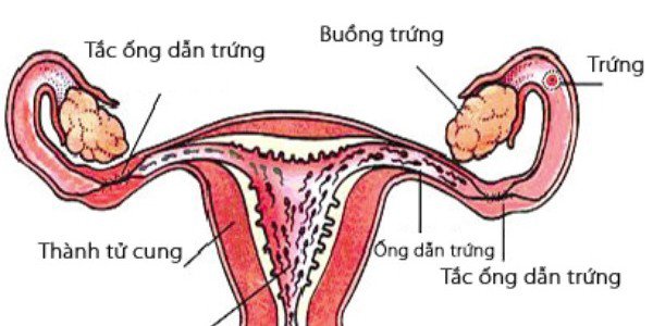 Vô sinh do tắc, ứ dịch ống dẫn trứng Vô sinh do tắc, ứ dịch ống dẫn trứng