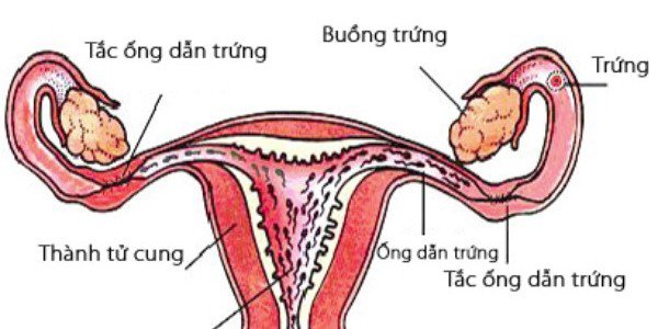 tắc nghẽn ống dẫn trứng