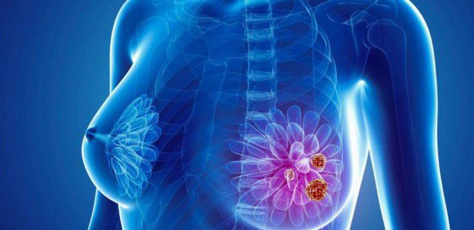 Đau dai dẳng sau phẫu thuật ung thư vú