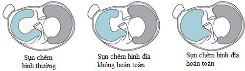 Sụn chêm đĩa hình