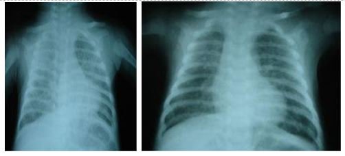 Viêm phổi Cytomegalovirus - Phần 1 Viêm phổi Cytomegalovirus - Phần 1