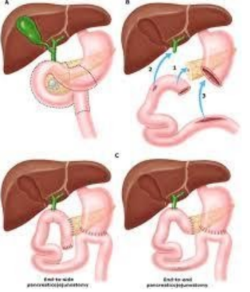 Kỹ thuật cắt khối tá tuỵ trong điều trị ung thư quanh bóng Vater