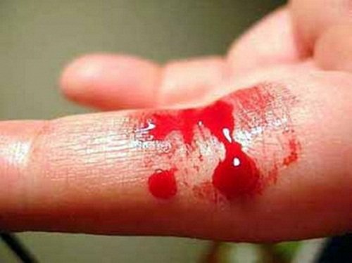 Bệnh Hemophilia là bệnh gì? Bệnh Hemophilia là bệnh gì?