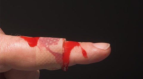 Bệnh Hemophilia là bệnh gì? Bệnh Hemophilia là bệnh gì?