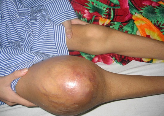 viêm khớp hemophilia