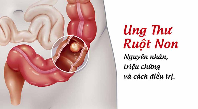 ung thư ruột non