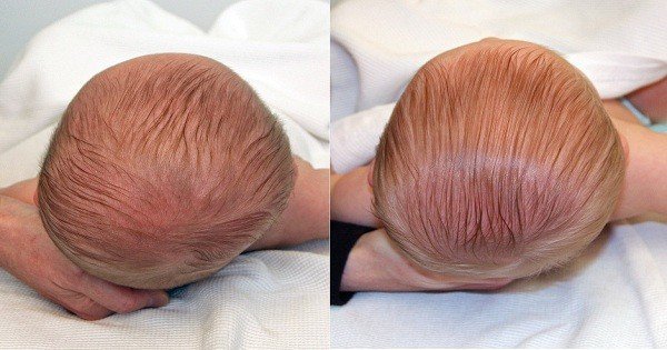 Nguyên nhân gây hội chứng đầu phẳng ở trẻ Nguyên nhân gây hội chứng đầu phẳng ở trẻ