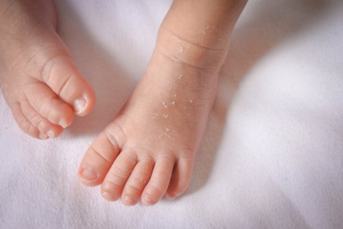Da khô ở trẻ sơ sinh