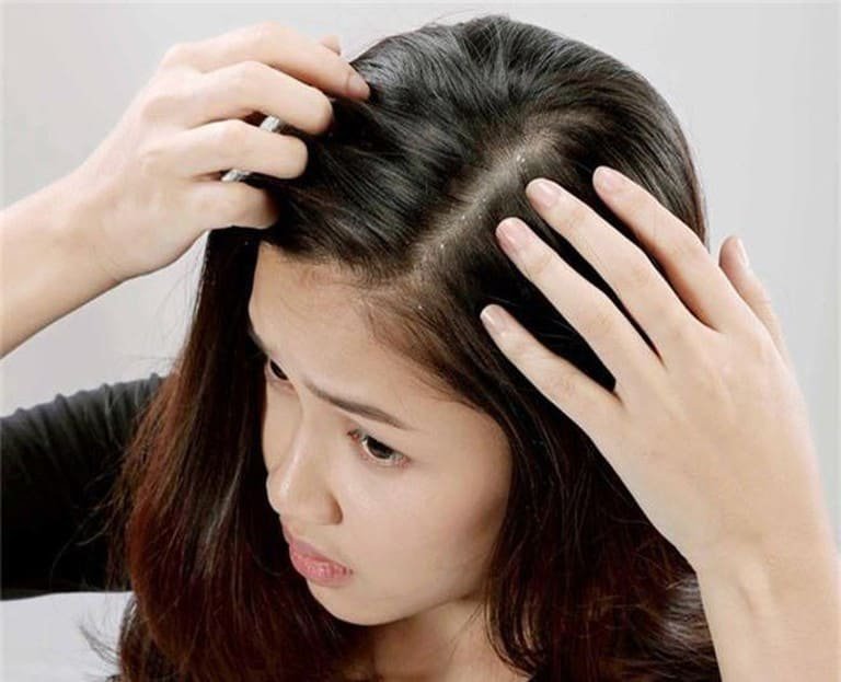 Dandruff, lots of hair loss, scratching bleeding is scalp fungus? Vinmec