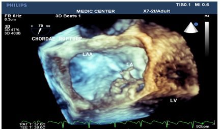 Siêu âm tim 3 chiều phát hiện đứt dây chằng van 2 lá