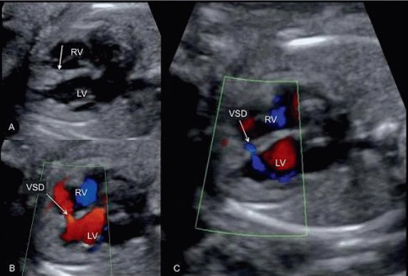 Hình ảnh thông liên thất trên siêu âm Doppler mặt cắt siêu âm mỏm tim