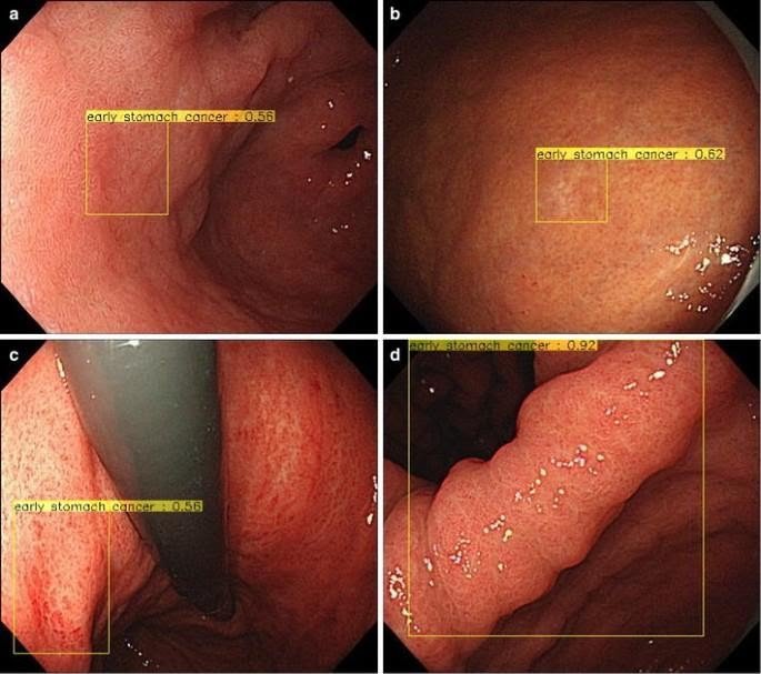 Tổn thương ung thư sớm dạ dày được phát hiện bằng trí tuệ nhân tạo