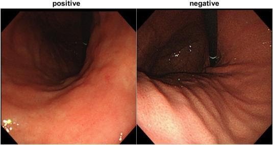 Hình ảnh nội soi đại diện của Helicobacter pylori dương tính và dạ dày âm tính