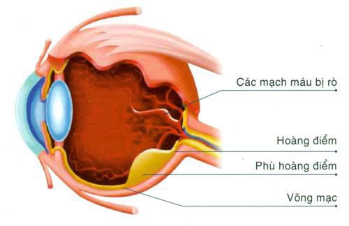 Phù hoàng điểm sau phẫu thuật đục thủy tinh thể