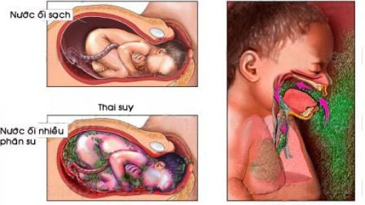Đặc điểm của dịch ối và các vấn đề thường gặp Đặc điểm của dịch ối và các vấn đề thường gặp