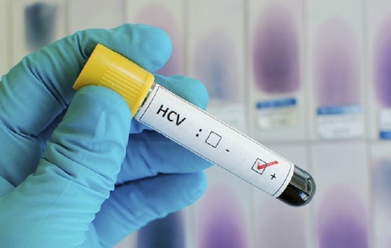 What To Do With Anti HCV Reactive 2 51 Test Results Vinmec