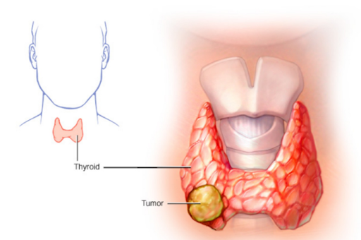 Sau phẫu thuật tuyến giáp đa nhân tế bào Carcinoma bị khàn giọng là do đâu?