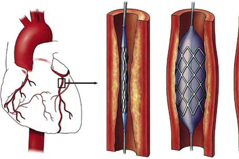Right brain and heart vascular occlusion and kidney failure should have coronary stents? Vinmec