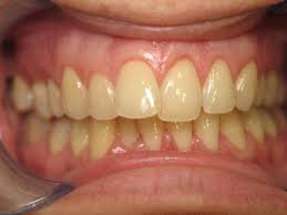 Các nguyên nhân khiến răng bị xỉn màu Các nguyên nhân khiến răng bị xỉn màu