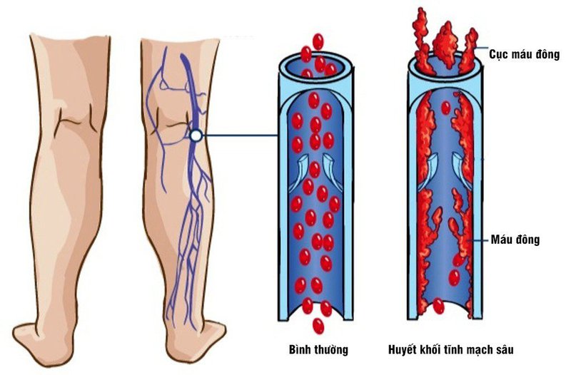Huyết khối tĩnh mạch sâu đùi phải, tĩnh mạch chủ bụng, tĩnh mạch chậu 2 bên, huyết khối nhánh phân thuỳ sau dưới động mạch phổi trái dùng thuốc Sintrom 4mg x 1/4 viên/ngày có được không?
