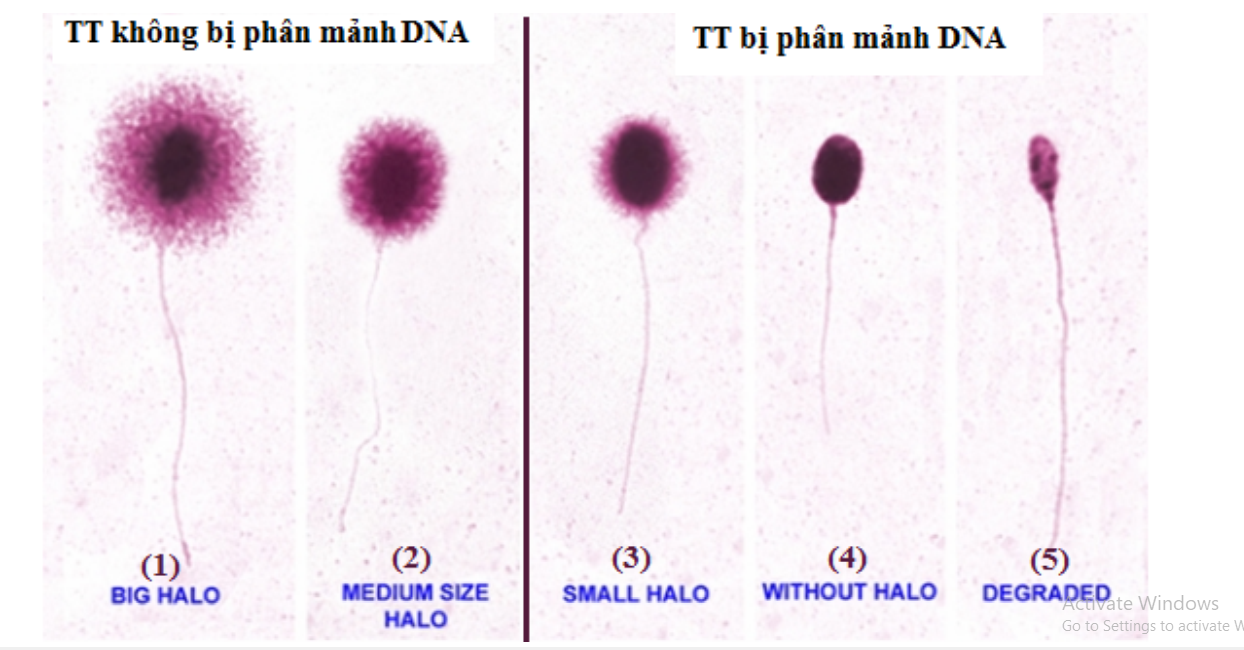 Xét nghiệm phân mảnh DNA tinh trùng trong chẩn đoán hiếm muộn Xét nghiệm phân mảnh DNA tinh trùng trong chẩn đoán hiếm muộn
