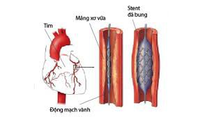 So với sử dụng stent thông thường, đặt stent phủ thuốc có tỷ lệ tái hẹp mạch vành thấp hơn đáng kể