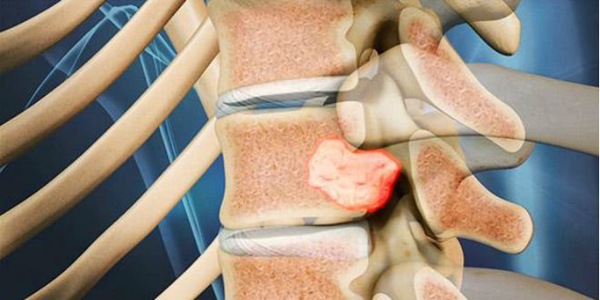 Chẩn đoán u trong ống sống bằng kỹ thuật y tế nào? Chẩn đoán u trong ống sống bằng kỹ thuật y tế nào?