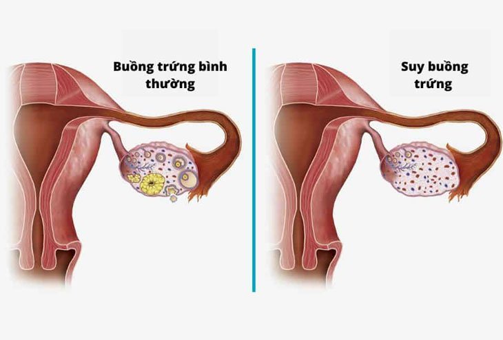 Vô sinh do bất thường về phóng noãn Vô sinh do bất thường về phóng noãn