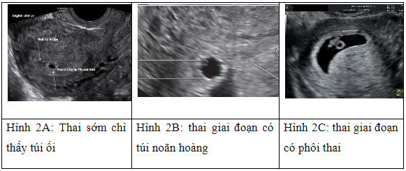 Một số cập nhật về siêu âm chẩn đoán chửa ngoài tử cung Một số cập nhật về siêu âm chẩn đoán chửa ngoài tử cung