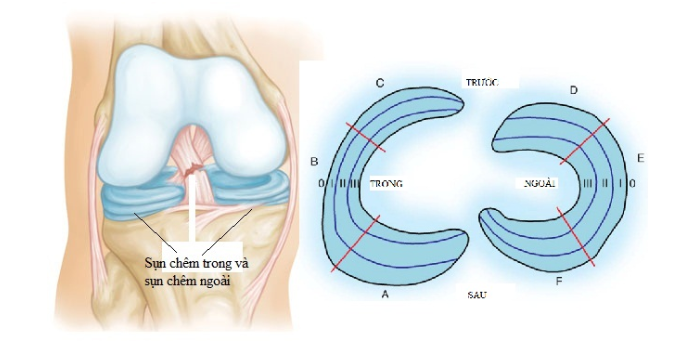 Nang sụn chêm khớp gối