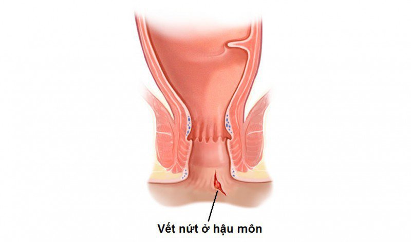 Nứt hậu môn