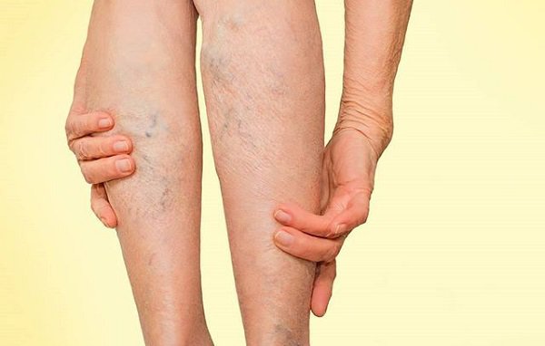 Sau khi bị huyết khối tĩnh mạch: Cần xử trí thế nào? Sau khi bị huyết khối tĩnh mạch: Cần xử trí thế nào?